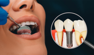 A10. Pasindora@newsin.ro@implant dentar valcea 1